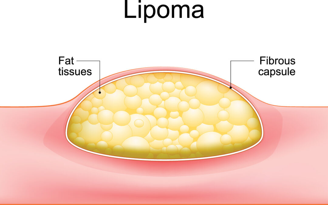 Lipoma Removal